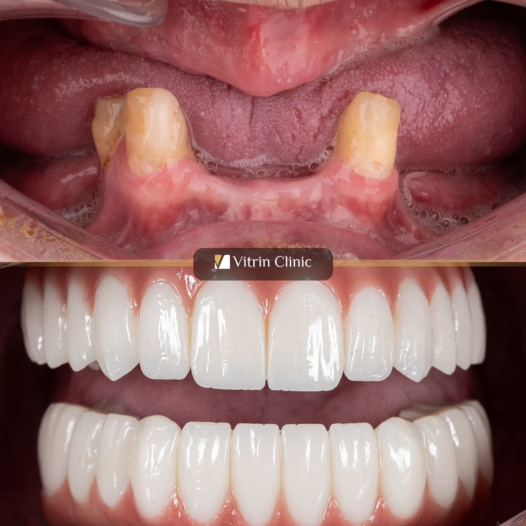 Dental Implant Failure in Patients With Diabetes: Causes, Risks, and Treatment Options
